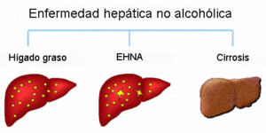 Enfermedad hepática grasa no alcohólica copia